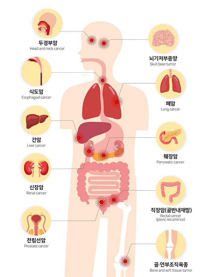 중입자치료를 받을 수 있는 암 종류