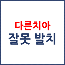사랑니 발치 예정이었으나 제2대구치를 발치한 사례